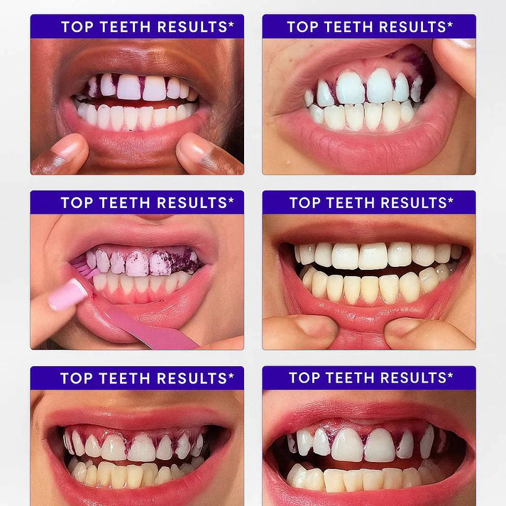 MORVAIL Purple Teeth Whitening Strips