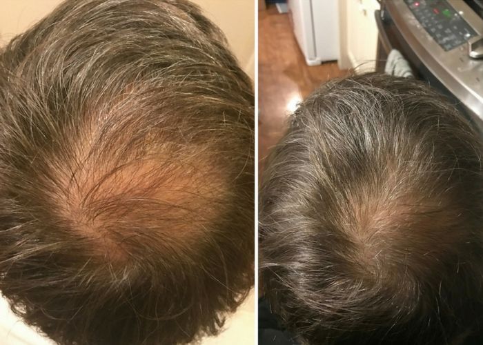 Root Activator Shampoo before and after result