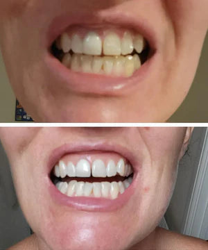 MORVAIL Purple Teeth Whitening Strips